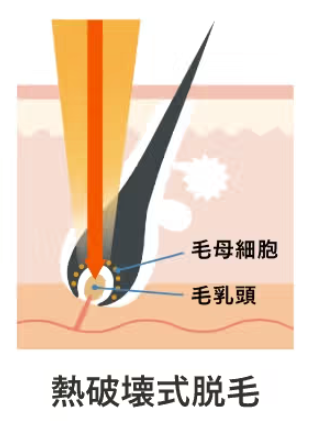 熱破壊式脱毛